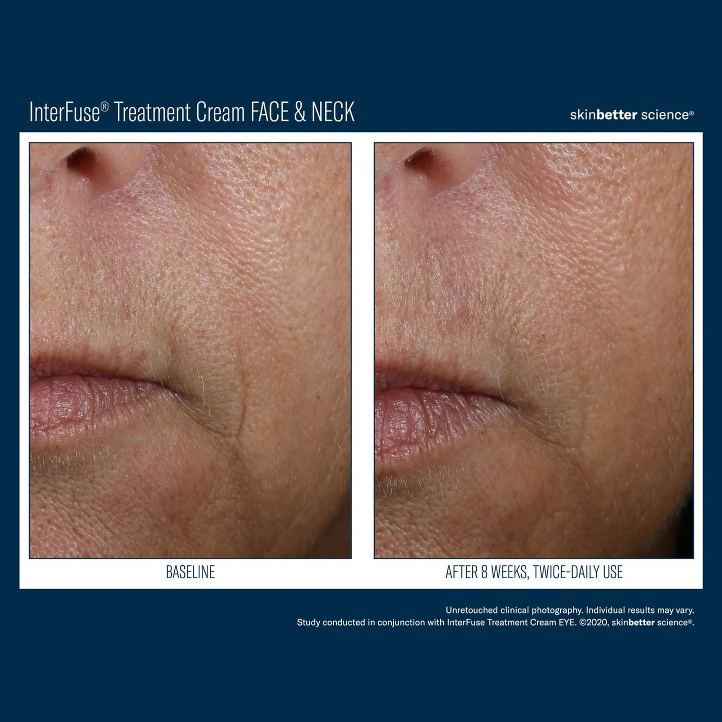 Interfuse treatment cream clinical before after skin tightening