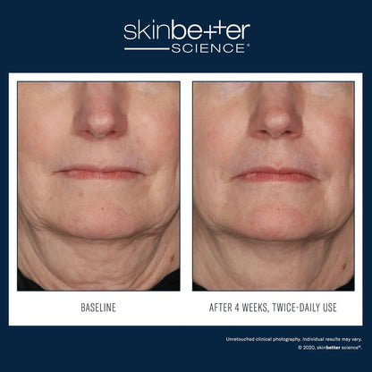 Interfuse treatment cream before and after results on face