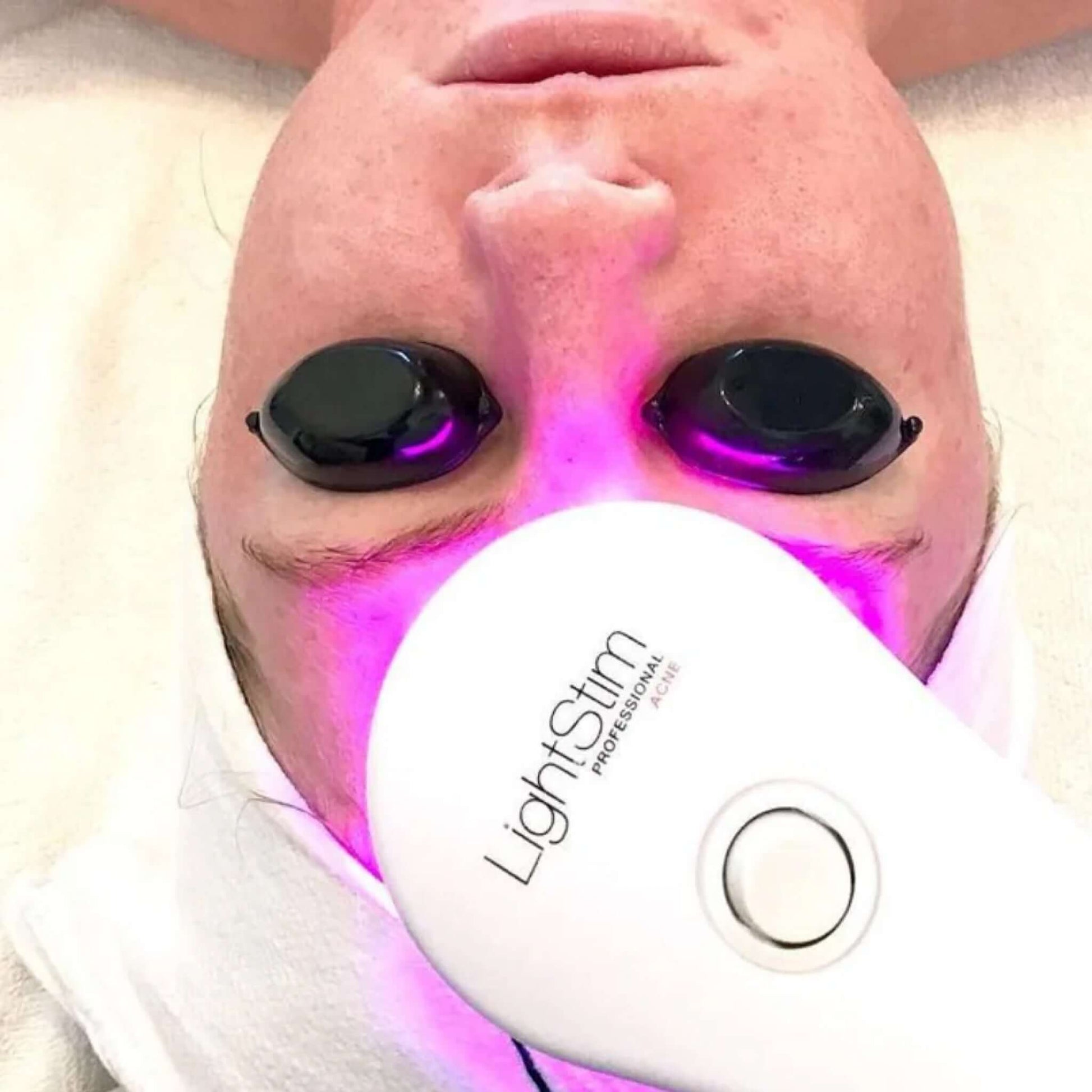 Lightstim-HandheldAcne